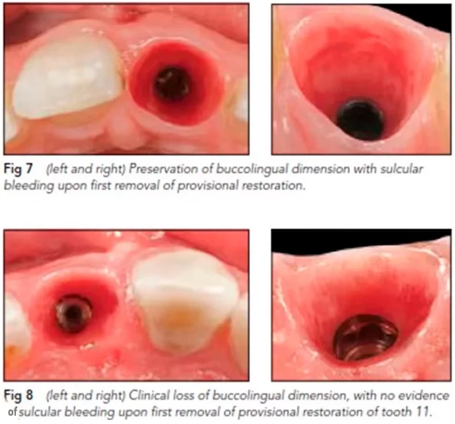 Signs of bleeding during removal of a temporary structure