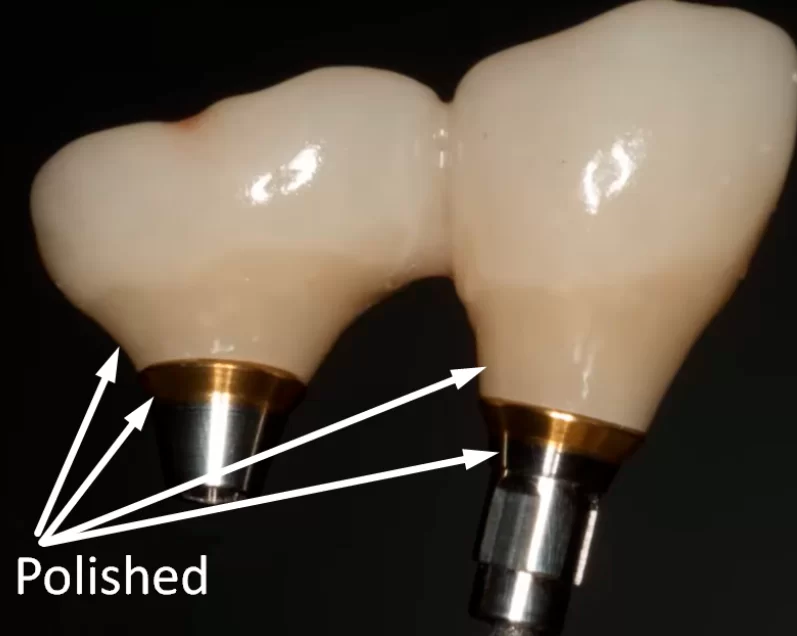 Two implant restoration - abutment bases are titanium nitride coated