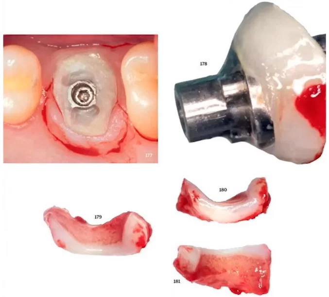 Experiments from dr tarnow's book - study of the tissues that were in contact with the composite healing cap