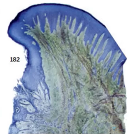 Histological section of the patient's tissue