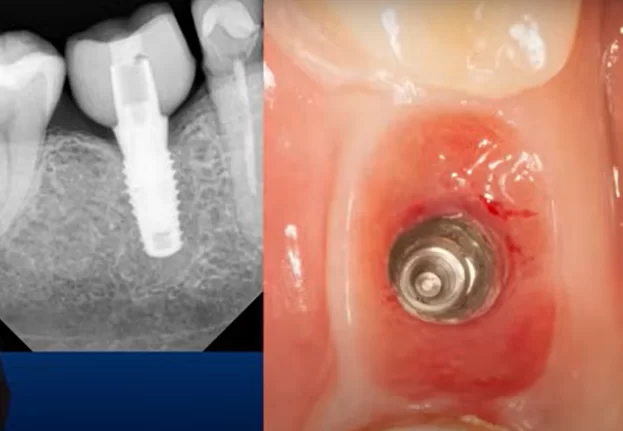 X-ray of the implant with crown and a picture of the hole after removal of the restoration