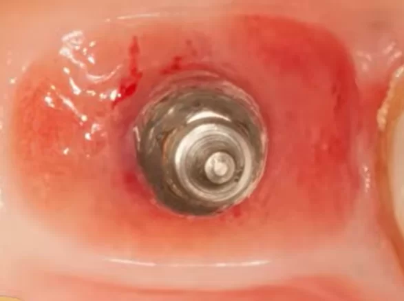 Dense and shiny epithelium in the hole immediately after abutment removal