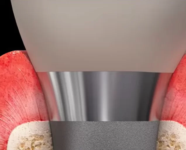 Perfect integration of the tissue level implant at bone and soft tissue level