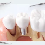 Soft tissue integration part 6. What to do if there are problems with attached keratinized gingiva