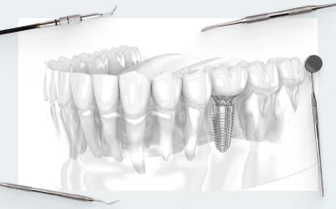 How long can an implant last? A review of a 20-year clinical study of patients who received fixed titanium implant restorations