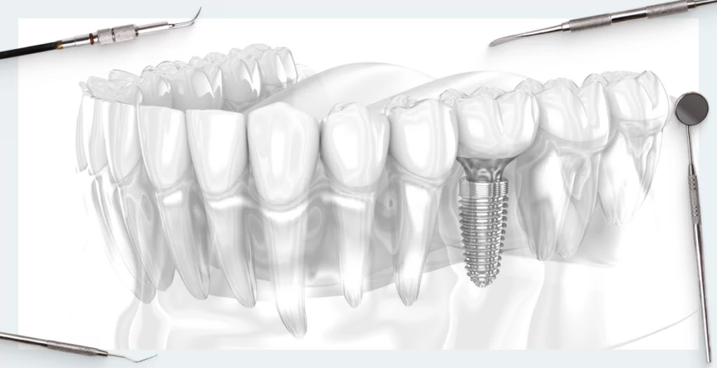 How long can an implant last? A review of a 20-year clinical study of patients who received fixed titanium implant restorations