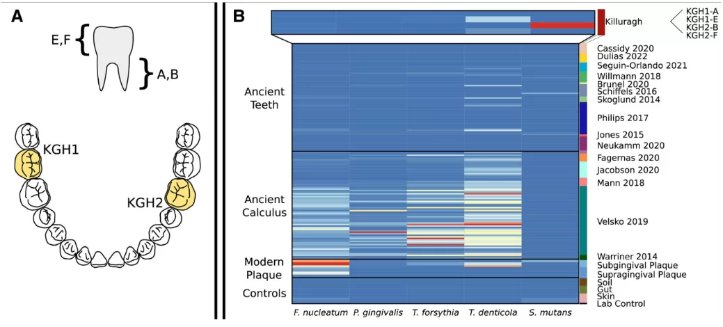 Oral microbiome retrieval from the early bronze age at killuragh cave. A) a schematic of sampling for this study. Two teeth were sampled—kgh1 (left mandibular second molar) and kgh2 (right mandibular first molar). An aliquot was taken from each root (a and b, respectively) and each crown (e and f). B) normalized relative abundance of 5 common oral pathobionts for ancient teeth, calculus and modern microbiome samples (human microbiome project consortium 2012; lloyd-price et al. 2017) and a lab control from our sequencing. Relative abundance is normalized to the highest abundance sample for each taxon (s. Mutans: 10. 6%, kgh2-b; tr. Denticola: 4. 5%, cs05; t. Forsythia: 30. 6%. Cs36; p. Gingivalis: 13. 3%, cs32; f. Nucleatum: 8. 1%, srr062298): color is scaled within species. Ancient samples are labeled and colored by publication (skoglund et al. 2014; warinner et al. 2014; jones et al. 2015; schiffels et al. 2016; philips et al. 2017; mann et al. 2018; willmann et al. 2018; velsko et al. 2019; brunel et al. 2020; cassidy et al. 2020; fagernäs et al. 2020; jacobson et al. 2020; neukamm et al. 2020; seguin-orlando et al. 2021; dulias et al. 2022).