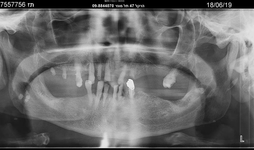 X-ray (orthopantomogram) of both jaws