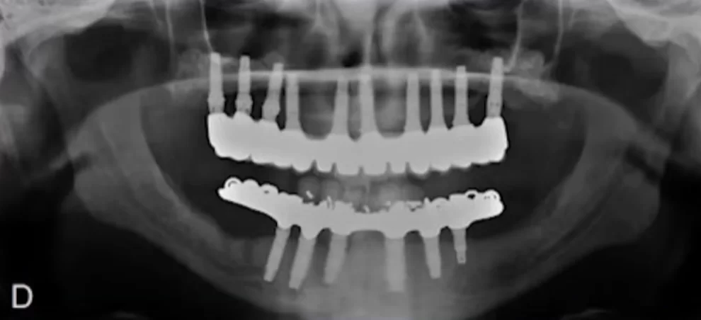 X-ray of a successful complete restoration of both dentitions