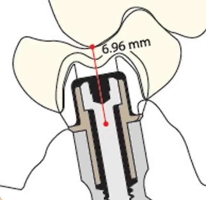 In such a clinical situation, it is necessary to use screw fixation of prosthesis