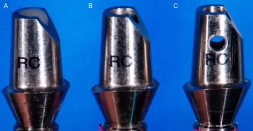 Screw vs. Cement fixation of crowns on implants: part 1 screw vs. Cement fixation of crowns on implants 11