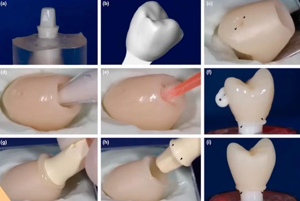 Method to reduce the amount of excess cement under the crown