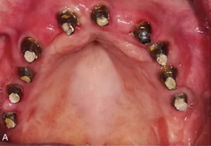 Screw-retained abutments (full arch restoration)