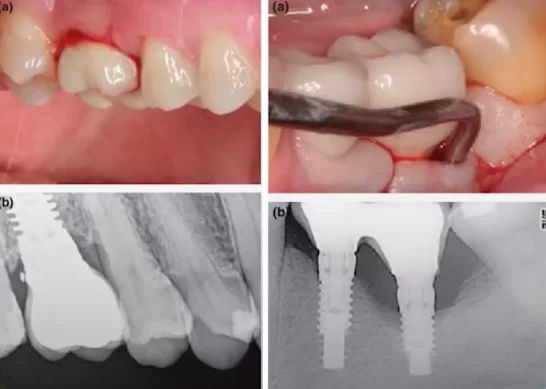 Inflammation and suppuration in the area of cement-fixed restoration