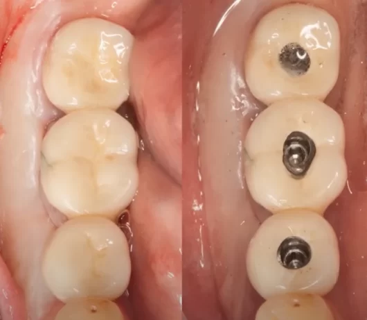 Screw channels for restorations with screw retention