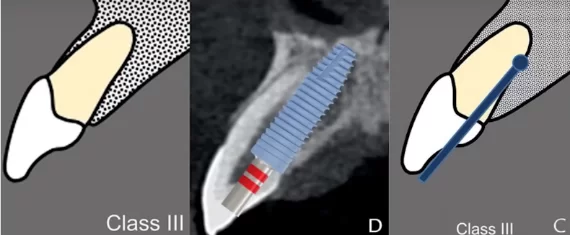 Drilling in the apical direction, parallel to the axis of the tooth and with a displacement of the drill axis palatally - the screw shaft would go to the edge of the tooth, so you need to place a crown with cement fixation