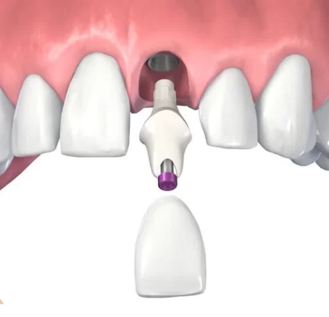 Cementation on a custom ceramic abutment