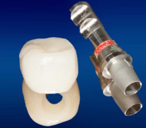 Crown with screw shaft and abutment prepared for screw fixation of the prosthesis