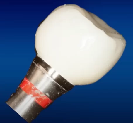 Abutment with a crown for screw fixation - treatment of a single defect