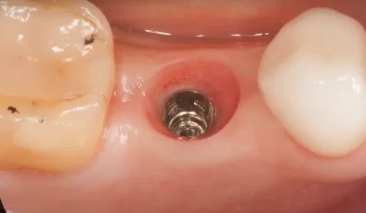 Single implant placed in good prosthetic position