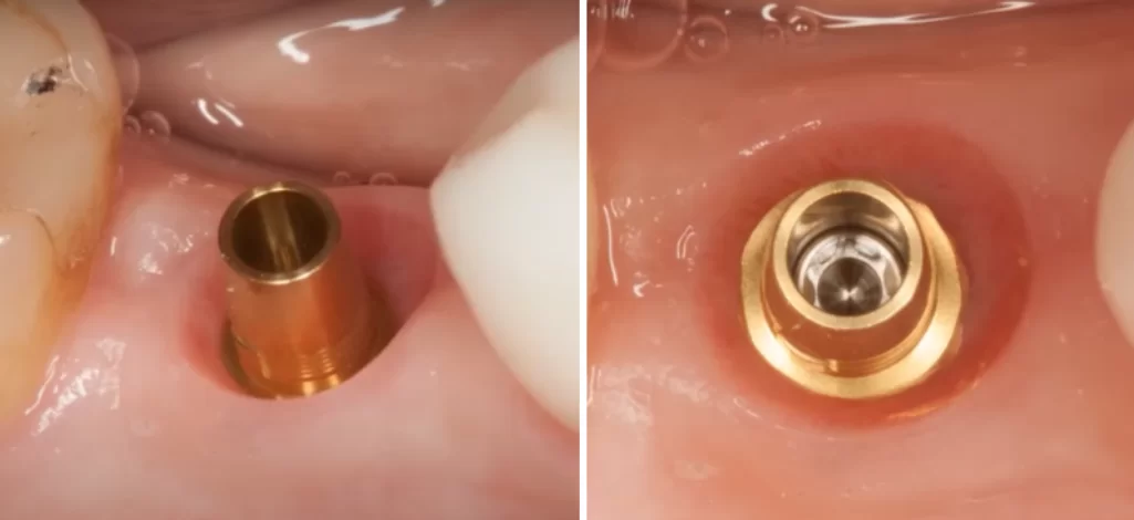 The gap between the crown and the abutment base exceeds 1. 5 mm below the soft tissue level