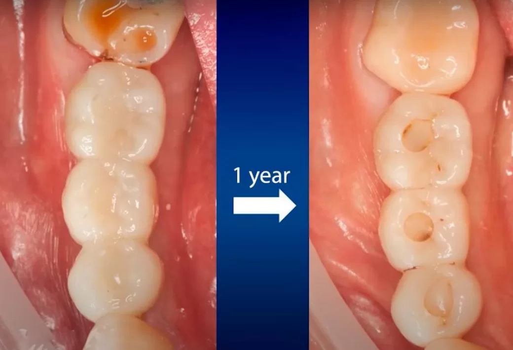 Darkening of the screw access channels observed one year after the prosthesis was placed with screw fixation