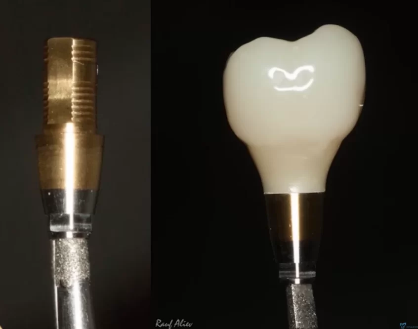 Abutment with anti-rotation features and a crown with an optimal eruption profile for single screw-retained restorations