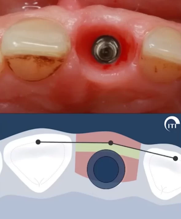 Screw vs. Cement fixation of crowns on implants: part 1 screw vs. Cement fixation of crowns on implants 41