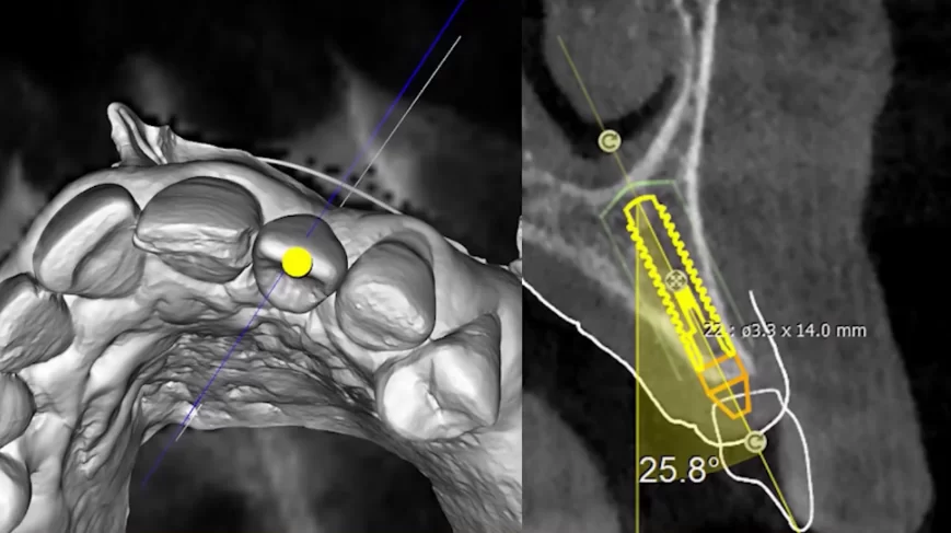 The process of planning the implant's location and the future crown involves considering the patient's bone tissue condition