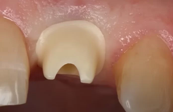 The junction between the crown and the abutment is positioned above the gum line, which facilitates the complete removal of any excess cement