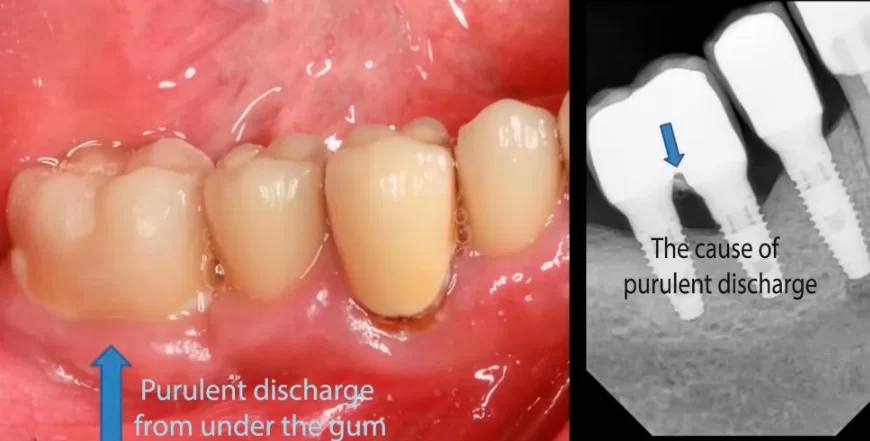 Purulent discharge around a paired restoration and cement residues on an x-ray