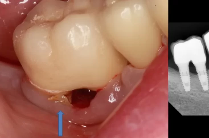 Surgical removal of cement residues - the inflammatory process has stopped