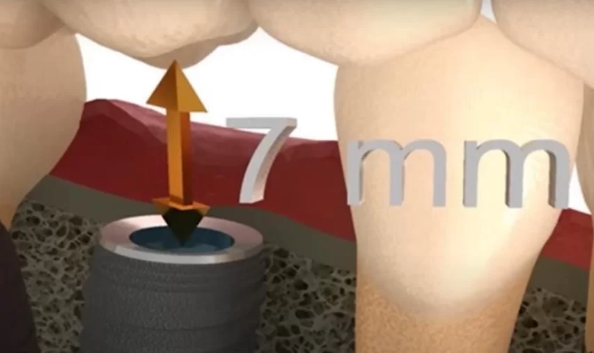 The critical distance from the base of the implant to the antagonist tooth at which only screw fixation should be used