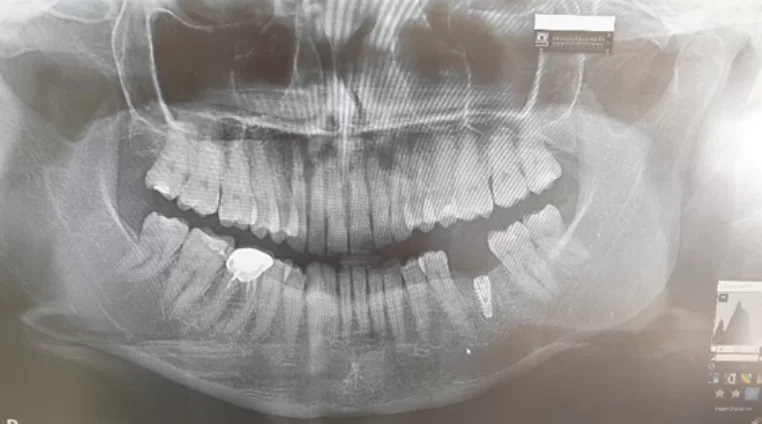 X-ray showing a successfully placed implant