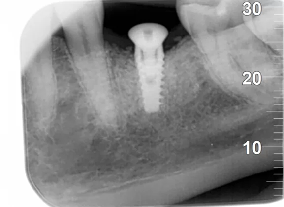 X-ray of the gingiva formation stage