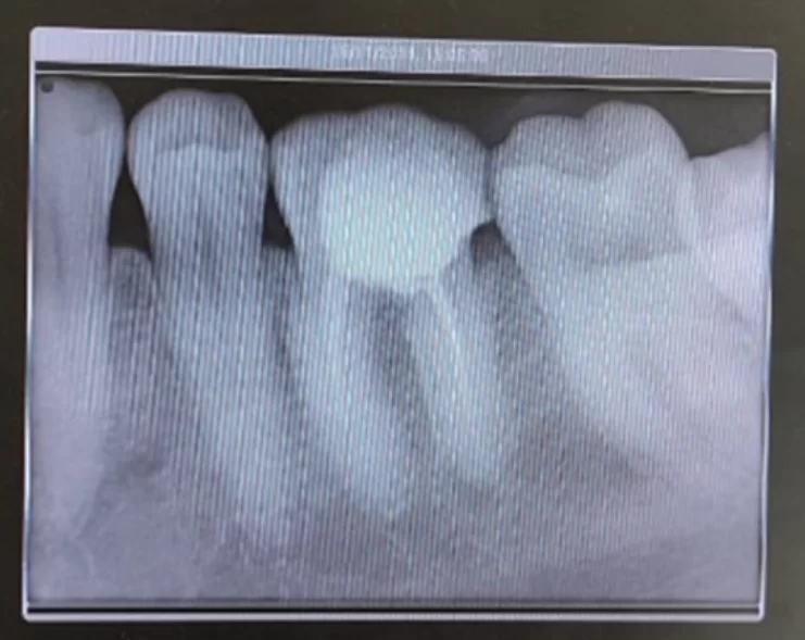 X-ray of a problematic tooth