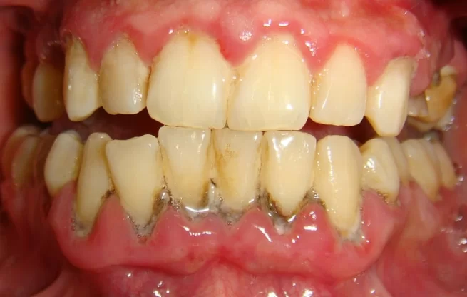 The impact of psychological stress on gum diseases