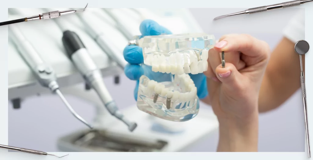 Screw vs. Cement Fixation of Crowns on Implants: Part 1