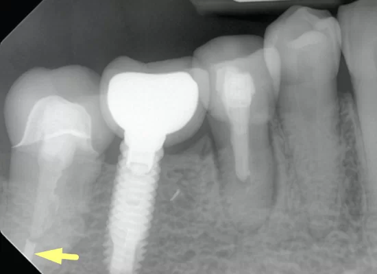 Fistulous tract attributed to tooth 45