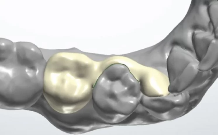 Final design of the temporary wing bridge for tooth 45 with an arm for retention