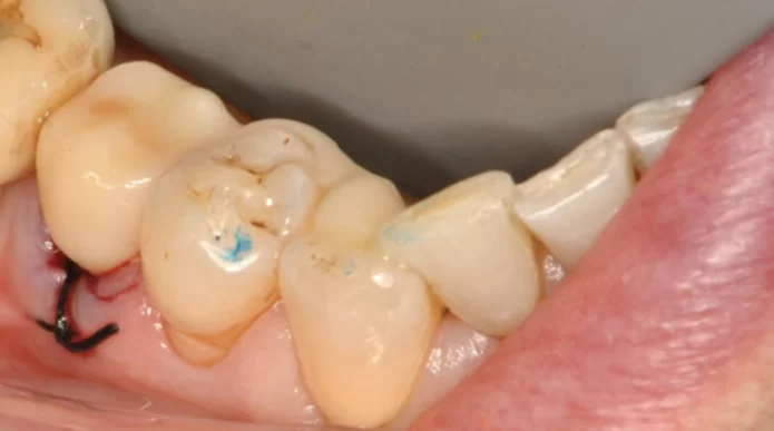 Successful temporary restoration of tooth 45