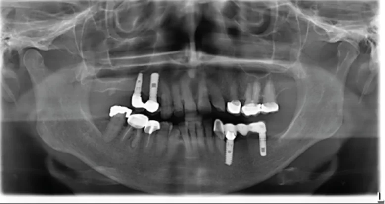 The condition of the patient’s teeth after treatment of tooth 45