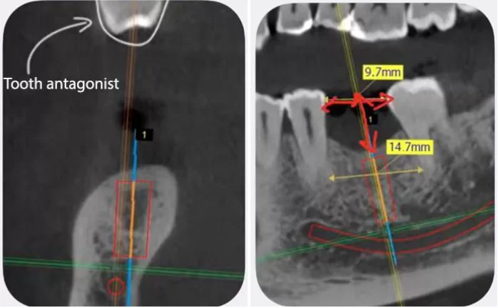 Plan of implant placement in the patient's mandible