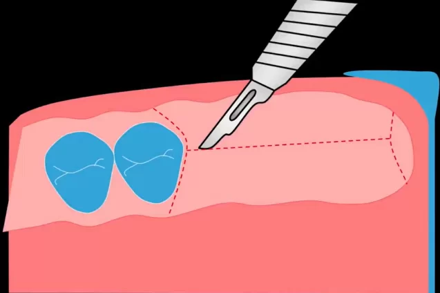 Recommended incision pattern for the placement of two implants