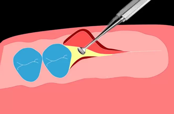 Flap detachment to access the alveolar ridge