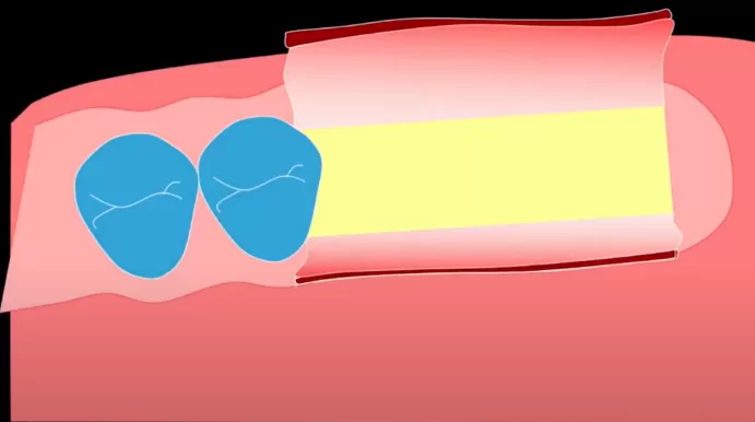 Exposed bone in the area of implant placement