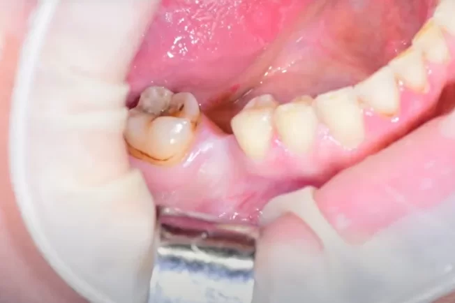 Initial clinical situation before implant placement