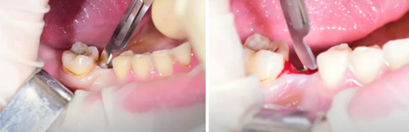 How to make a soft tissue incision for dental implant placement