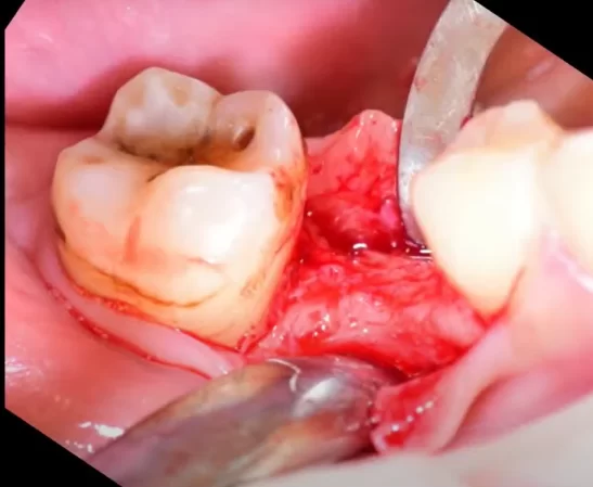 How to detach a flap to access the alveolar ridge