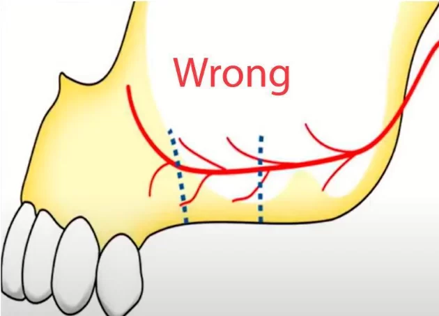 Unacceptable height of gingival incisions